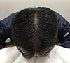 図1:高橋さん頭頂部の写真 図1:高橋さん頭頂部の写真